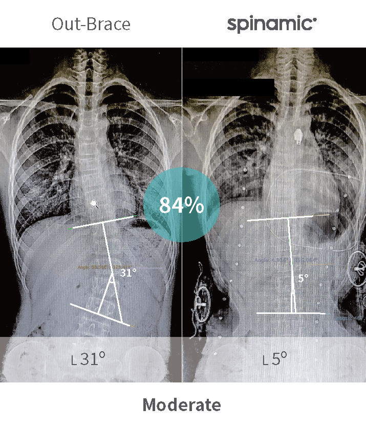 Moderate scoliosis Cobb angle correction case — 84% improvement