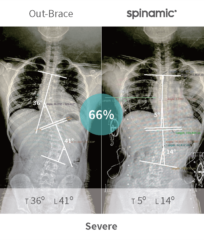 Severe scoliosis Cobb angle correction case — 66% improvement